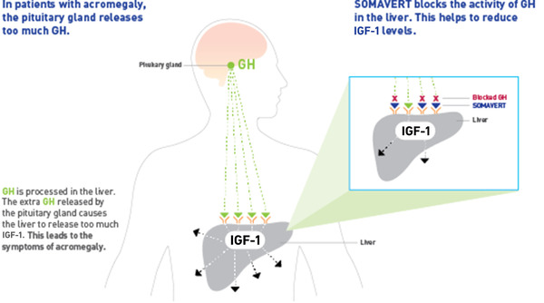 Infographic of how SOMAVERT blocks GH activity in the liver